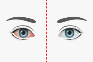sécheresse oculaire, Reddened unhealthy human eye with many distinct blood vessels and healthy eye. Concept of dry eye syndrome, ophthalmological diseases, health of eyes and visual system