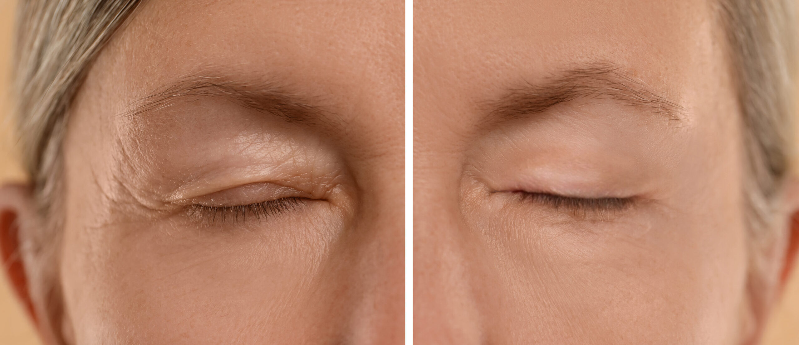 blépharoplastie, Aging skin changes. Woman showing face before and after rejuvenation, closeup. Collage comparing skin condition