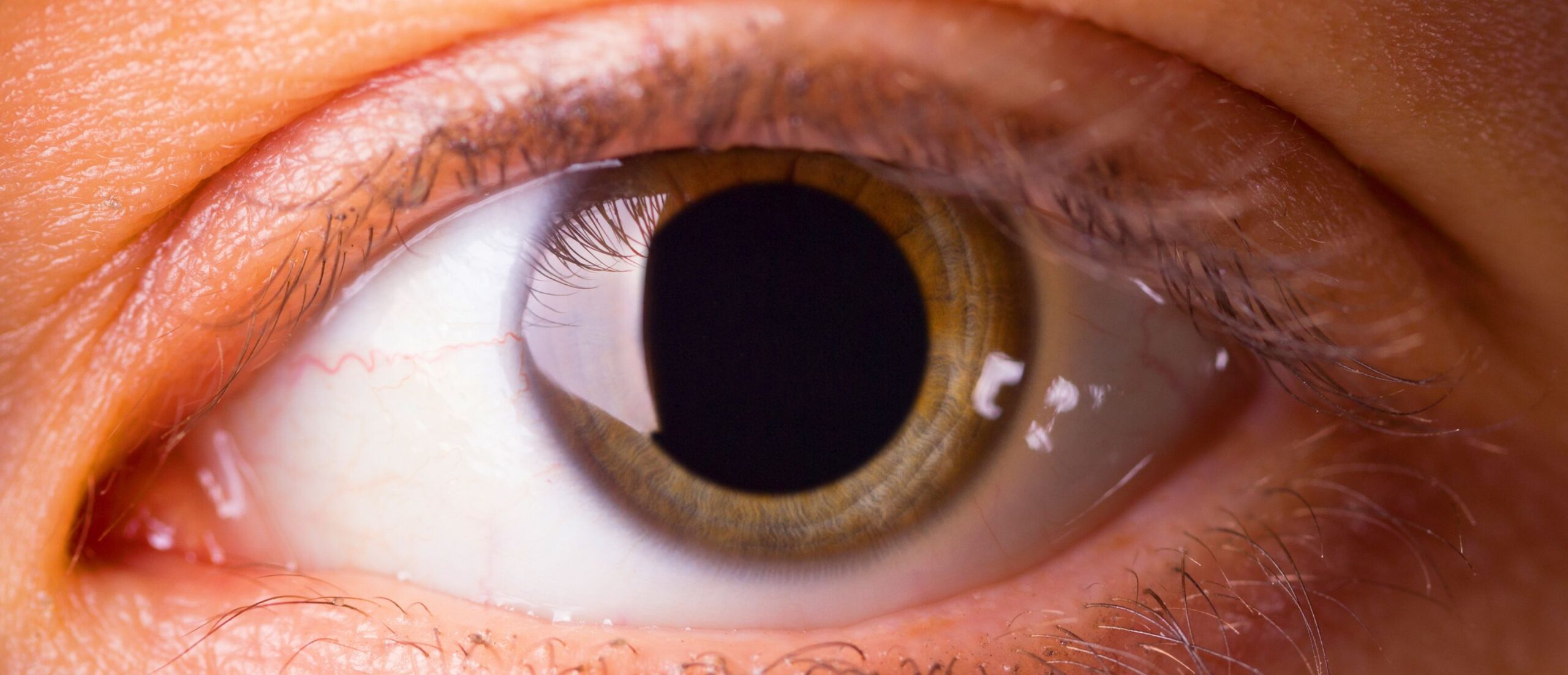 Oeil, pupille dilatée